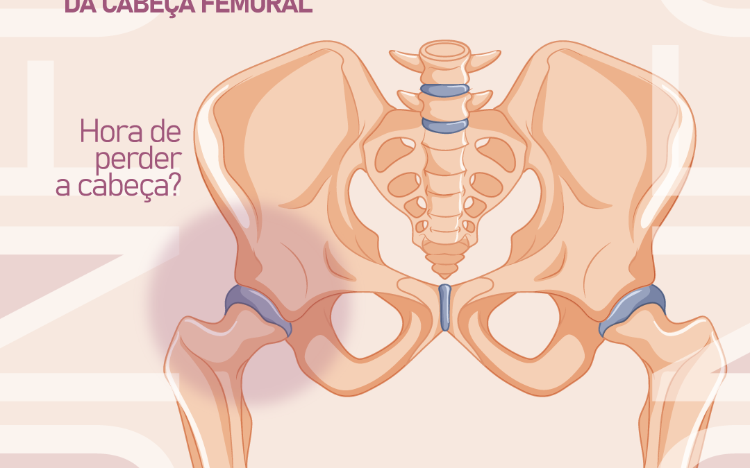 osteonecrose-da-cabeca-femoral-–-hora-de-perder-a-cabeca?