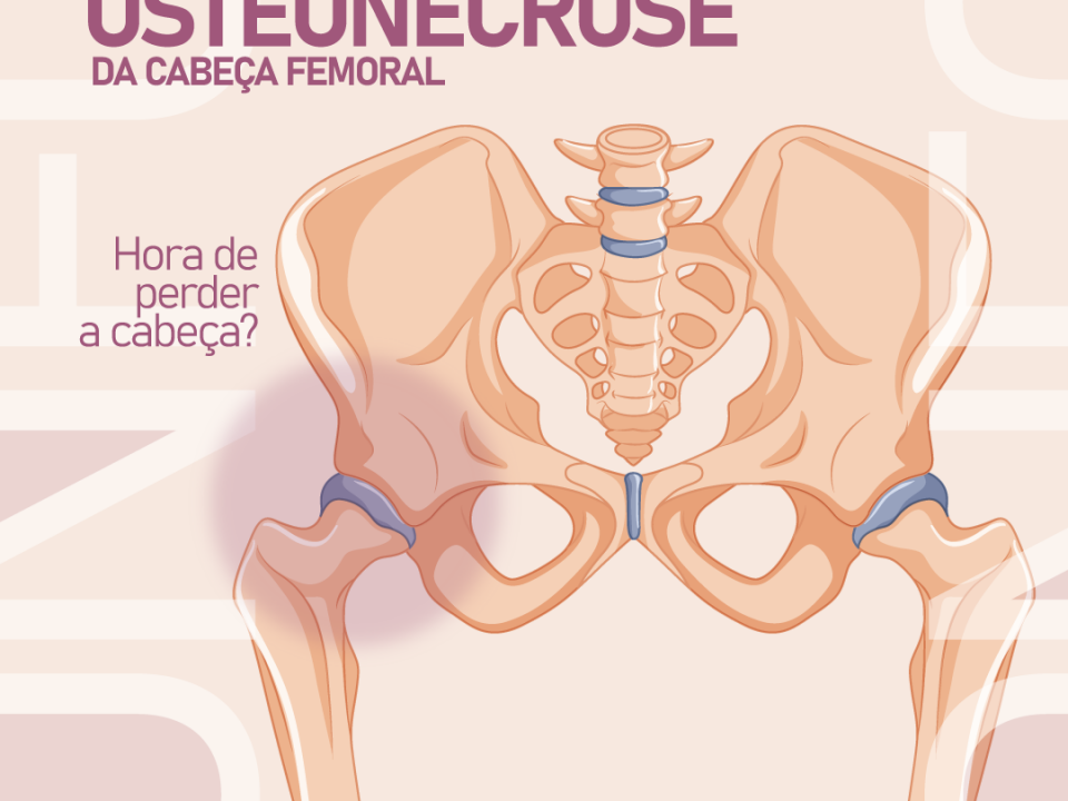 osteonecrose-da-cabeca-femoral-–-hora-de-perder-a-cabeca?